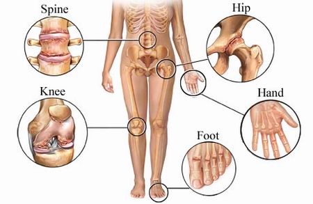 Osteoarthritis and Homeopathy